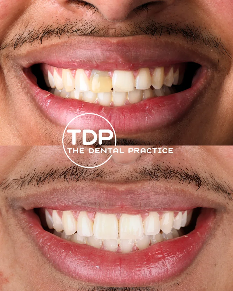 A patient before and after cosmetic treatment at The Dental Practice