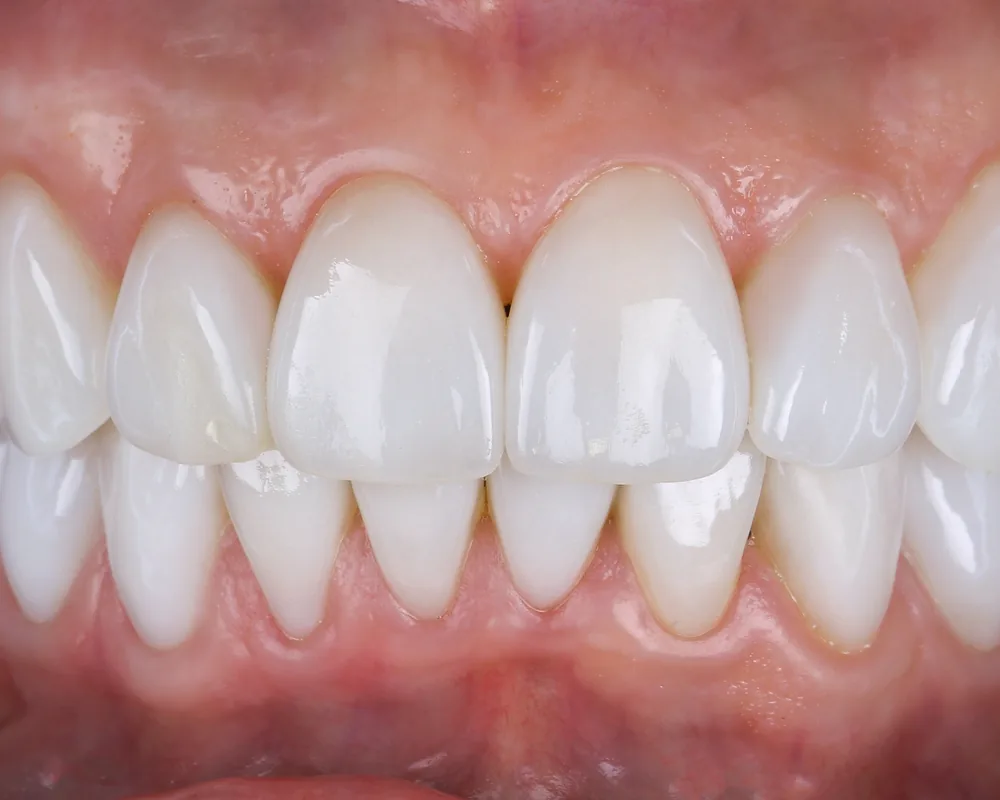 A close-up of a smile showing the upper and lower front teeth