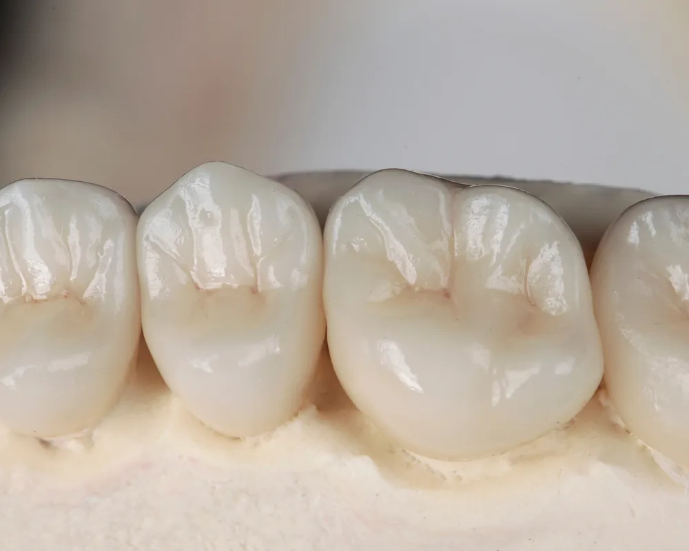 Dental crowns shown on a dental model