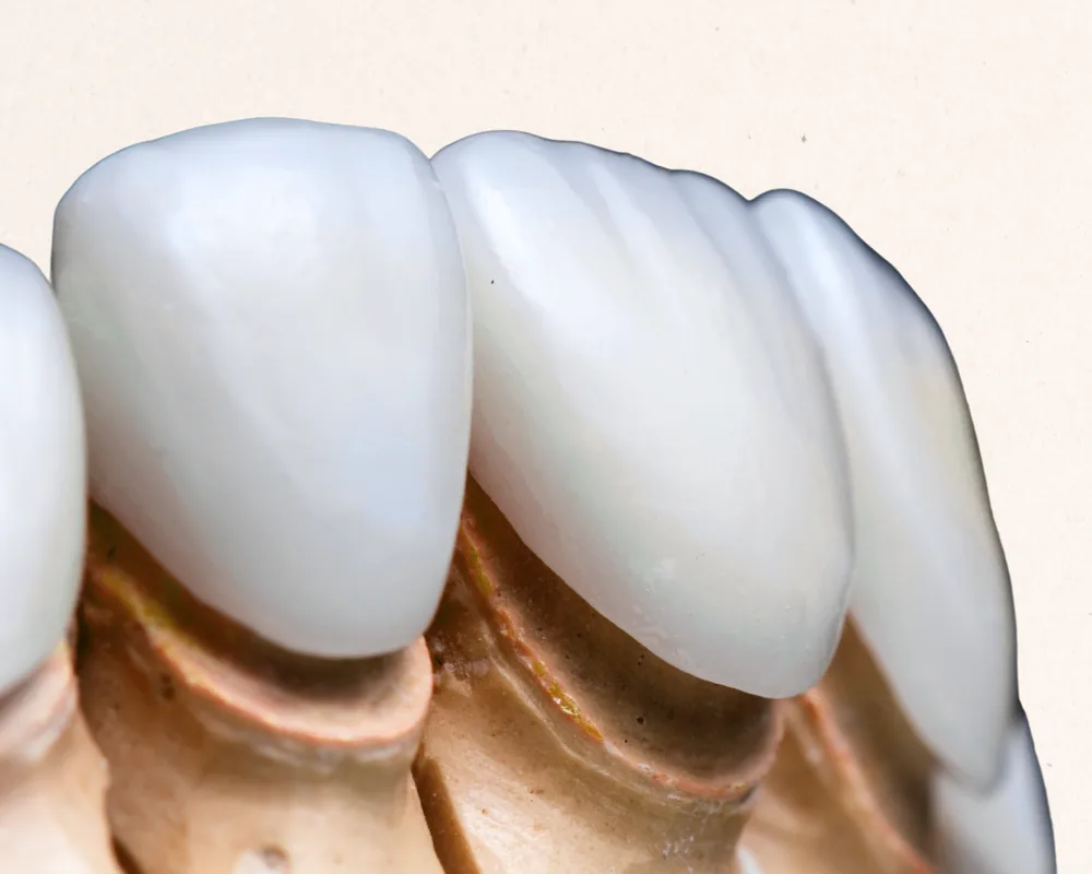 Porcelain veneers shown on a dental model