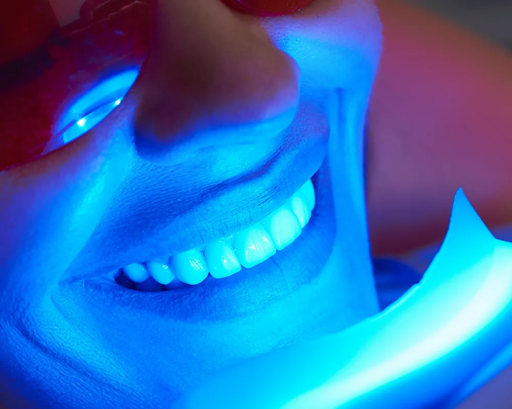 Professional in-chair teeth whitening being carried out